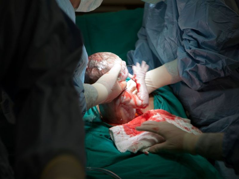 Quando è necessario fare il cesareo secondo le linee&nbsp;guida?